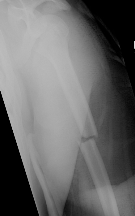 Undisplaced Humeral Fracture Lateral